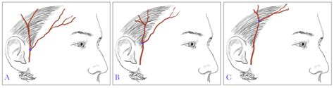 Temporal Artery Biopsy Statpearls Ncbi Bookshelf