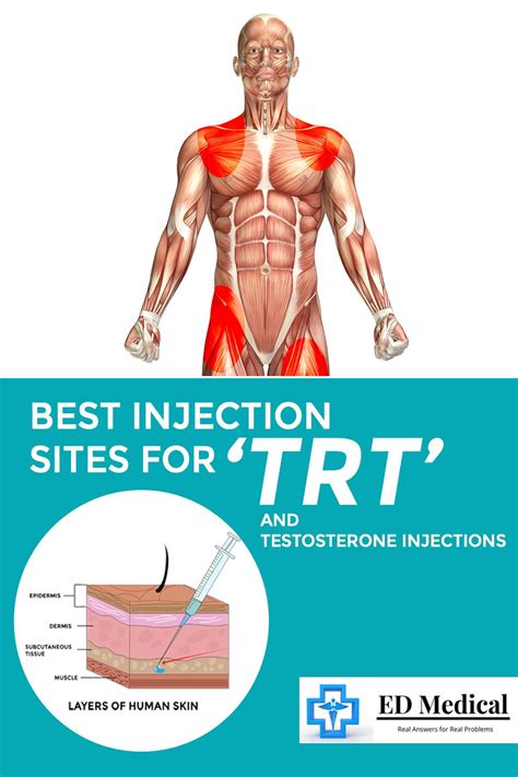 Testosterone Therapy: Optimal Injection Sites