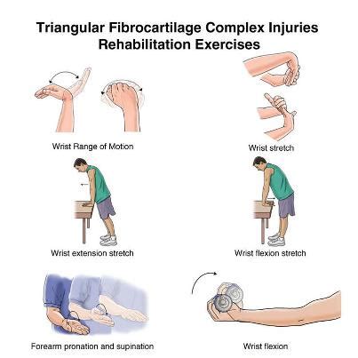 Tfcc Tear Repair Stretches Exercises Triangular Fibrocartilage