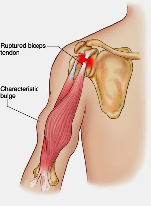 The Amazing Bodybuilding Biceps Tendon Rupture And Advances In