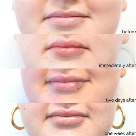 The Lip Filler Journey You Will Experience The Most Swelling And Some