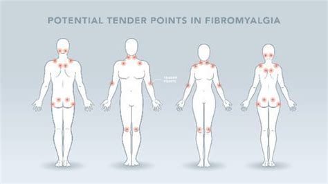 The Neuroscience Of Fibromyalgia Causes Diagnosis And Potential