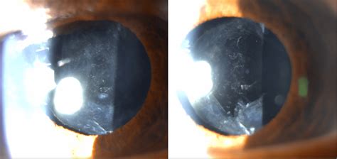 The Retina Clinic Yag Posterior Capsulotomy Laser