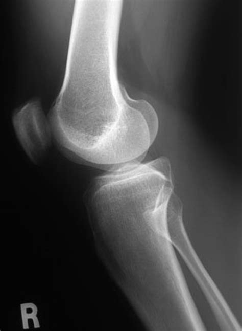 Three Different Types Of Knee X Rays With Photos Healdove