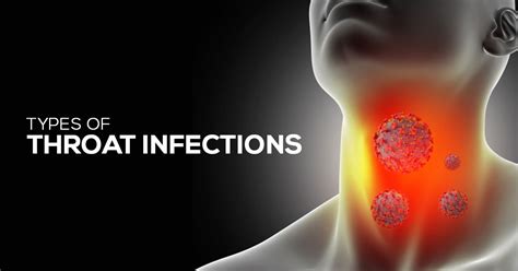 Throat Infections Guide: Diagnose & Treat