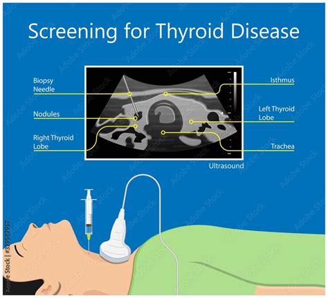 Thyroid Cancer Disease Nodules Ultrasound Screening Check Medical Treat