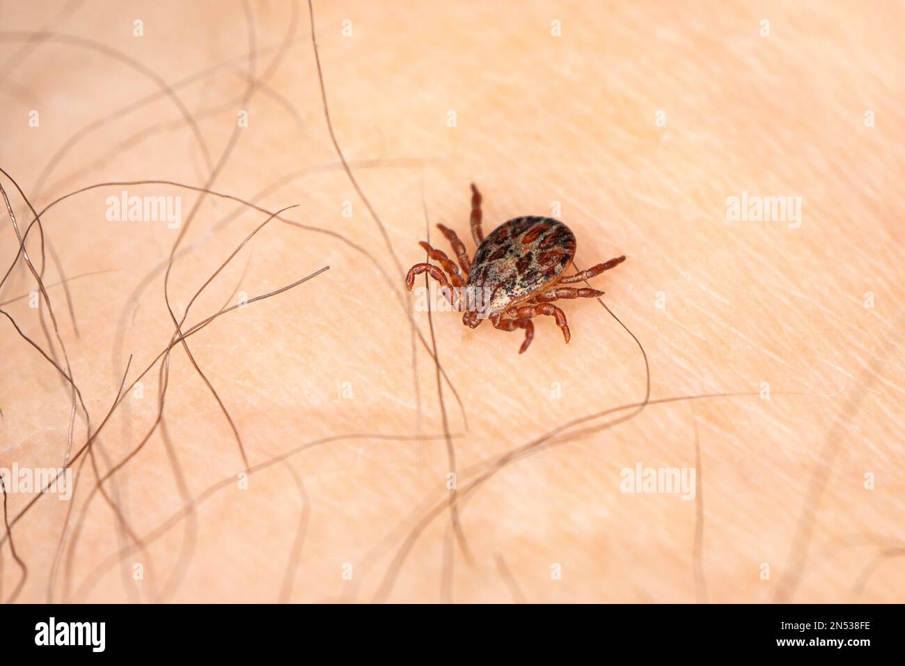 Ticks In The Hair