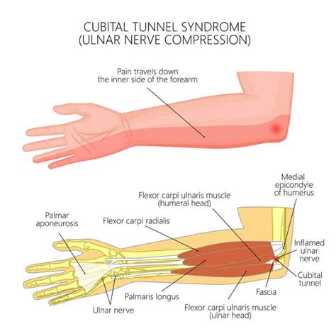 Tingling In Elbow