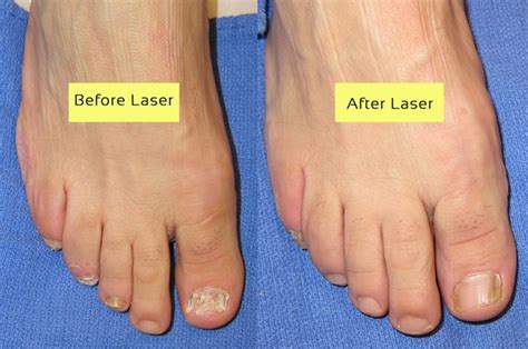 Toenail Fungus Laser Treatment Near Me Toenail Fungus Treatment