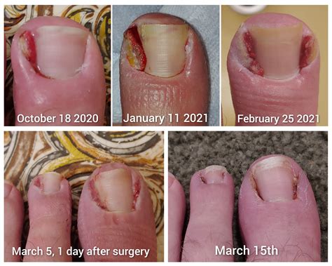 Toenail Removal Healing: See Recovery Pictures