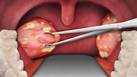 Tonsil Removal After