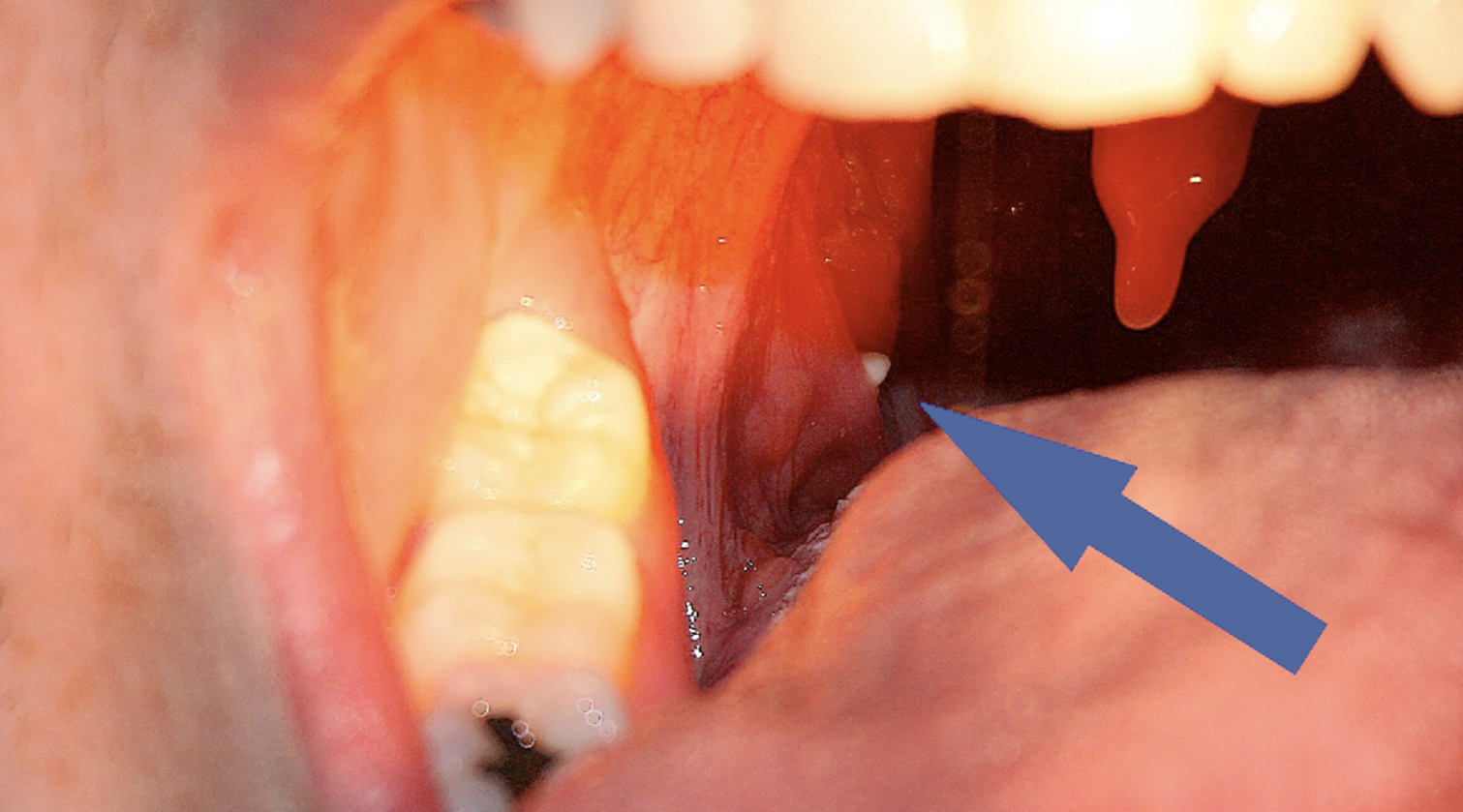 Tonsil Removal Age Limit