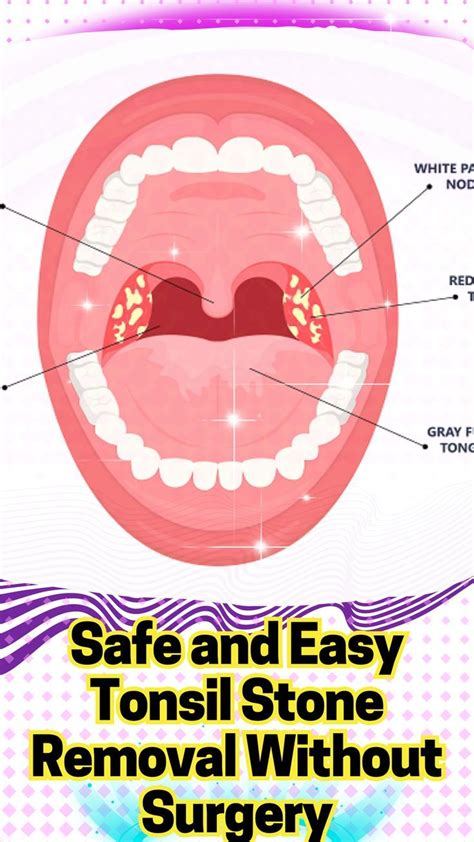 Tonsil Stones Removal: Safe And Easy Solutions