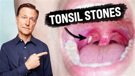 Tonsil Stones Smell