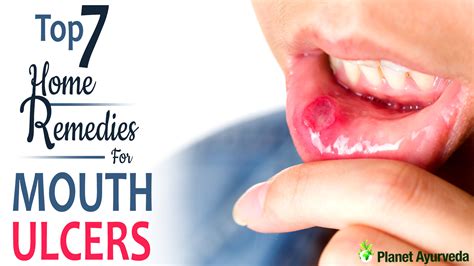 Top 10 Home Remedies To Cure Mouth Ulcers