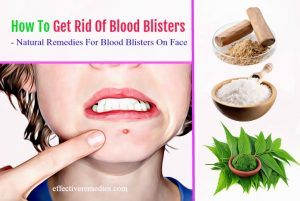 Top 17 Ways How To Get Rid Of Blood Blisters On Face In Mouth