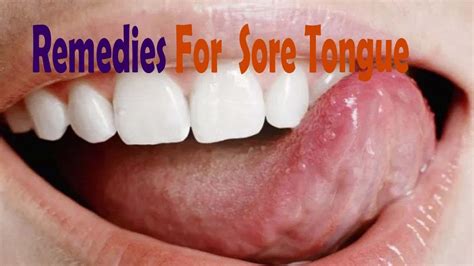 Top 6 Home Remedies For Sore Tongue Tongue Sores Sore Tongue