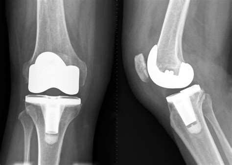 Total Knee Replacement Rheumatoid Arthritis Know More