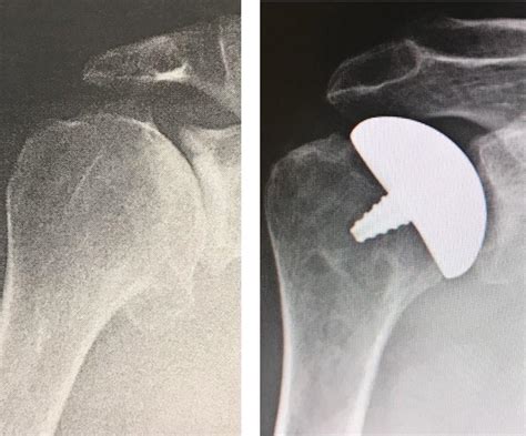 Total Shoulder Replacement Alternative Advantage Orthopedics