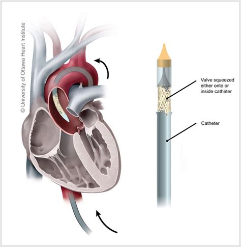 Transcatheter Heart Valve Implantation For Failing Surgical