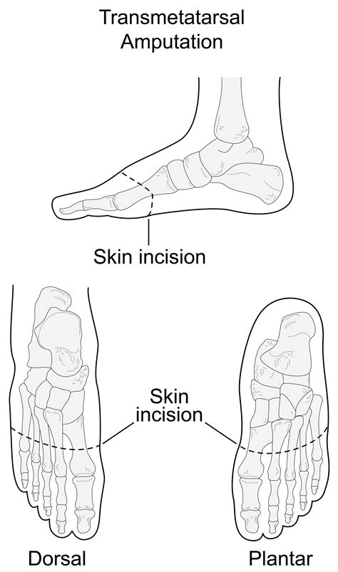 Transmetatarsal Amputation Tma And Toe Amputation Treatments