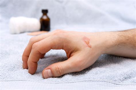 Treat Burns To Prevent Scarring Vinmec