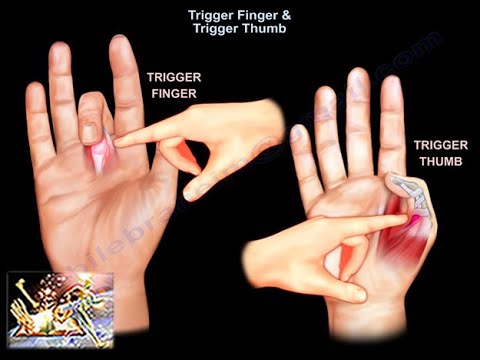 Trigger Finger Relief: Surgical Options Explained