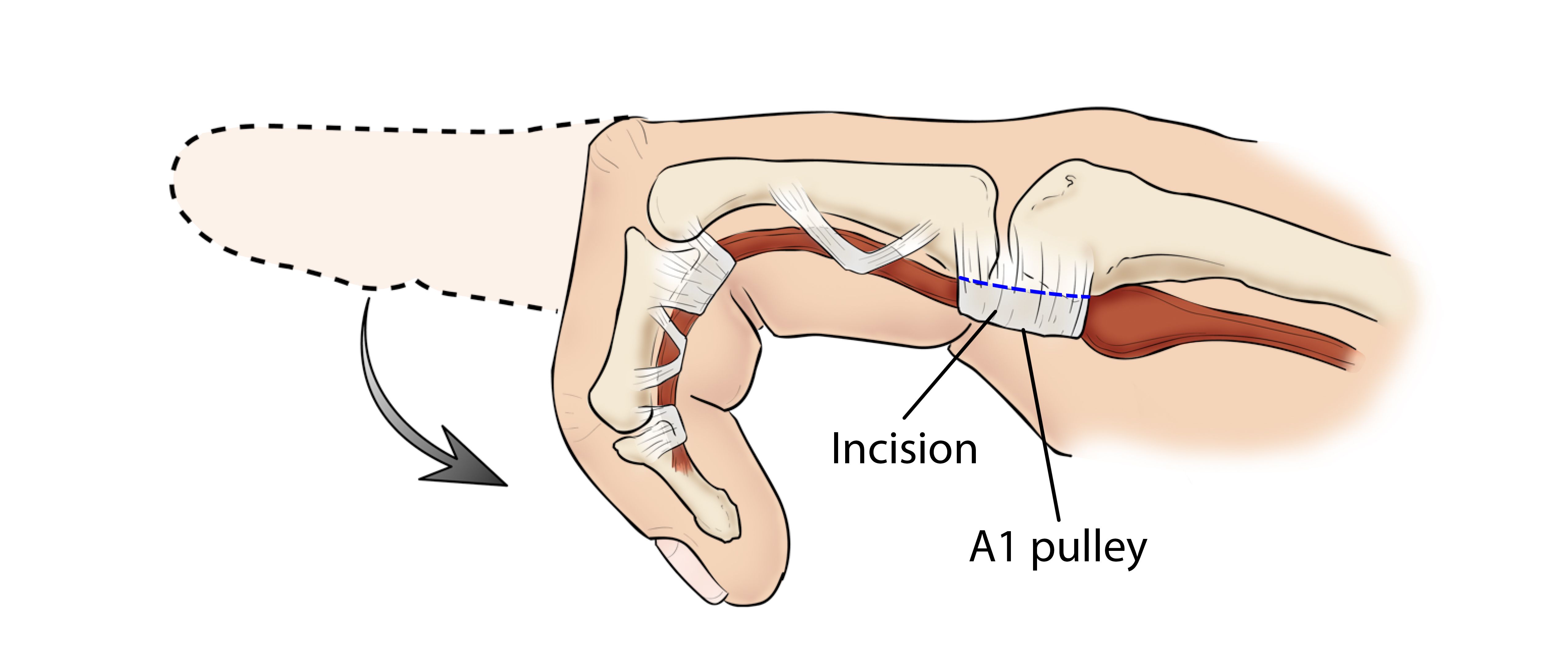 Trigger Finger Surgery: Restore Hand Function