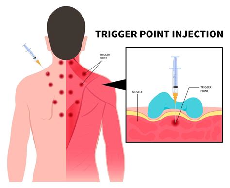 Trigger Point Injection Newport Beach Ca Myofascial Pain Syndrome