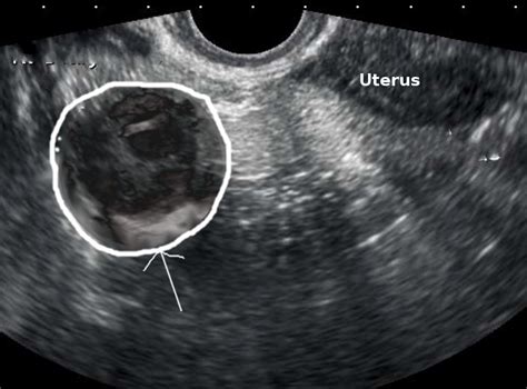 Tubo Ovarian Abscess: Expert Diagnosis And Care