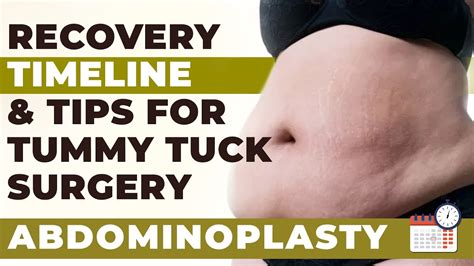 Tummy Tuck: Reduce Downtime Successfully