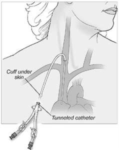 Tunneled Dialysis Catheter Placement Vascular Institute Of Virginia