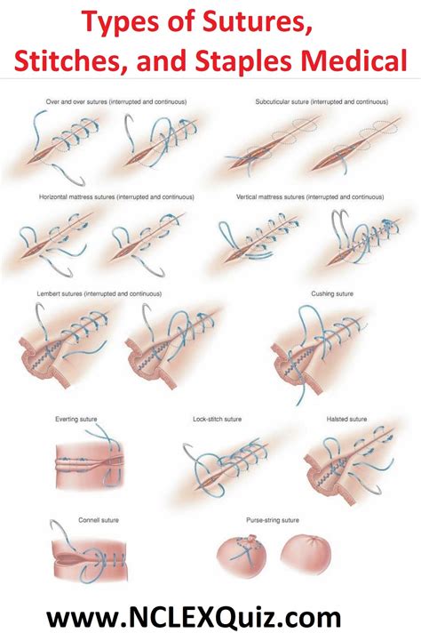 Types Of Sutures Stitches And Staples Medical Wound Care Suturing