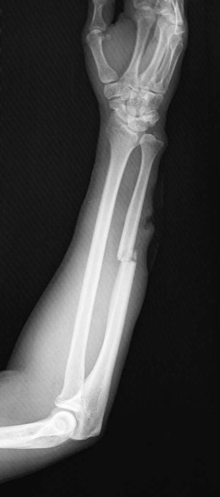 Ulna Hairline Fracture