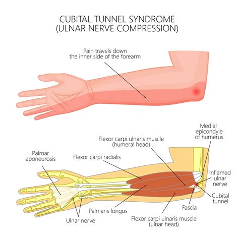 Ulnar Nerve Pain