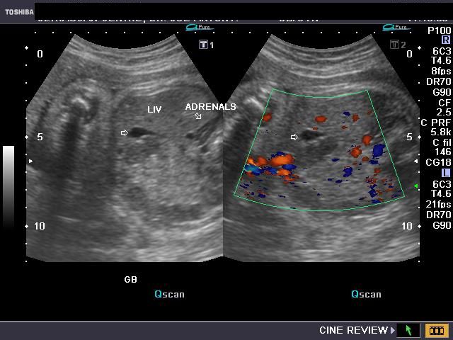 Ultrasound Evaluation Of Normal Second Trimester Fetal Anatomy