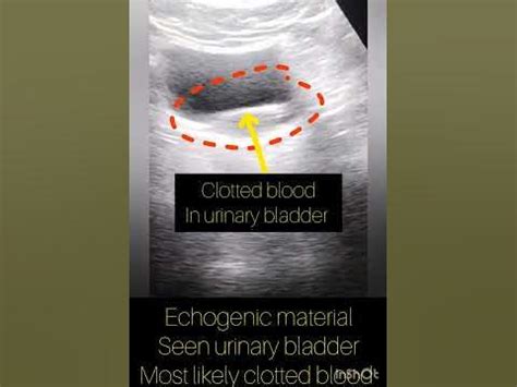 Ultrasound Showing Clotted Blood In Urinary Bladder Kub Ultrasound