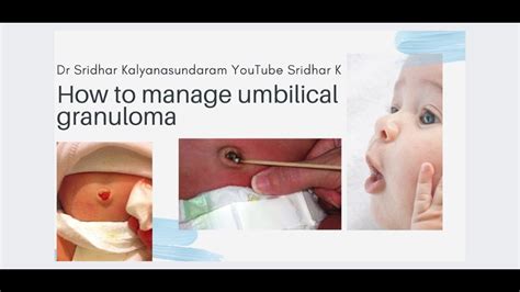 Umbilical Granuloma Treatment