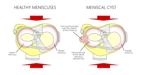 Understanding And Treating A Lump On The Side Of The Knee