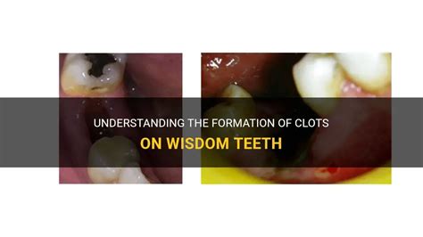 Understanding The Formation Of Clots On Wisdom Teeth Medshun