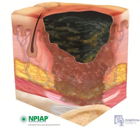 Unstageable Decubitus Ulcer