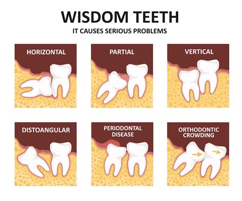 Unveiling The Secrets Orthodontists Vs Dentists In Wisdom Teeth Removal