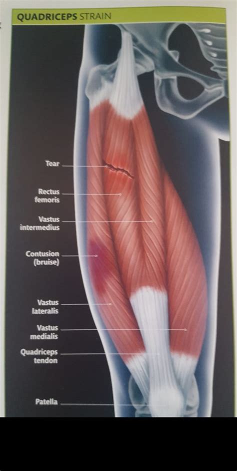 Upper Quad Strain: Heal Faster Now