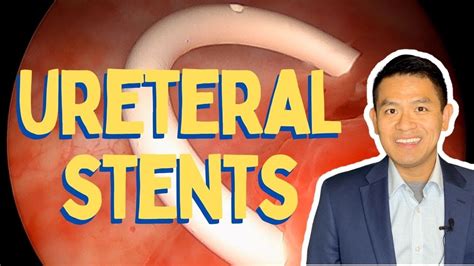 Ureteral Stent Removal: Painless Procedure Guide