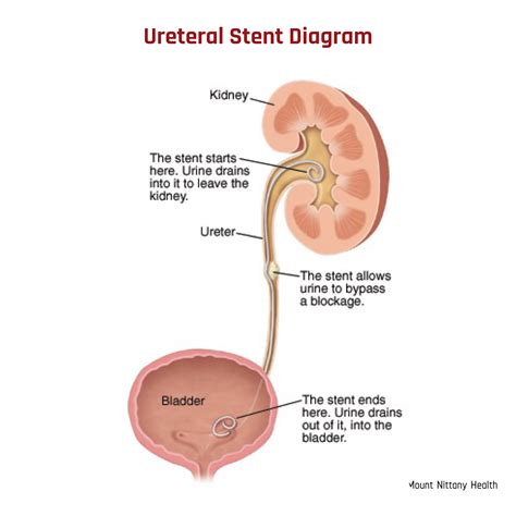 Ureteral Stents What You Need To Know