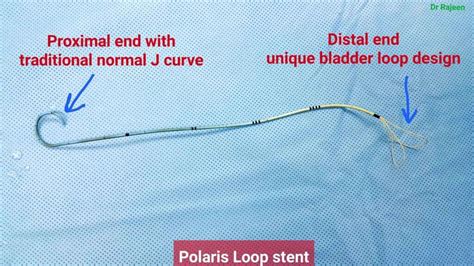 Ureteroscopy And Ureteric Stenting For Ureteric Stones Urology Malaysia