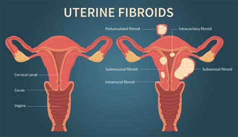 Uterine Fibroid Embolization Specialist Los Angeles Ca Amp Encino Ca