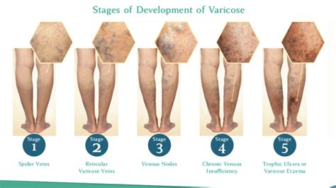 Venous Insufficiency Icd 10