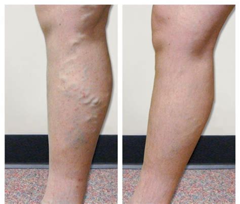 Venous Insufficiency Varicose Veins Vegas Vascular Specialists