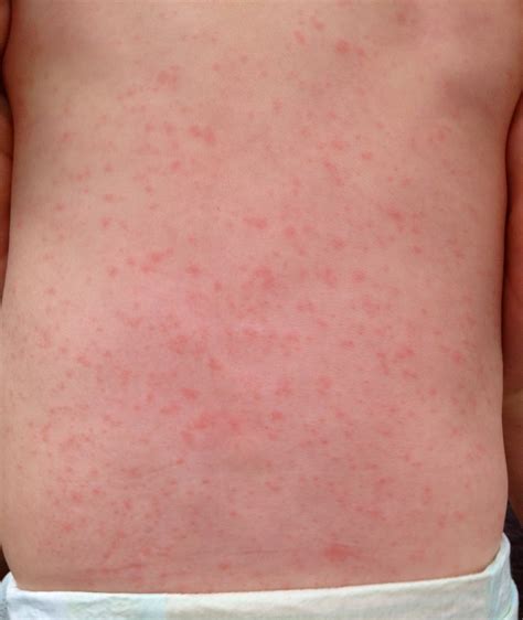 Viral Rash Toddler